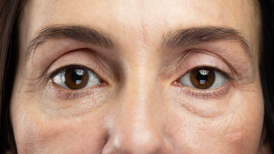 regard avec cernes et fatigue