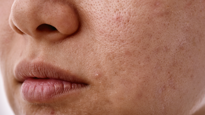 Combination Skin: The Best Tips for Pampering It