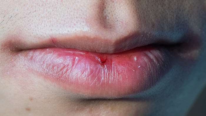 Réparer Les Lèvres Abîmées: Conseils et Astuces