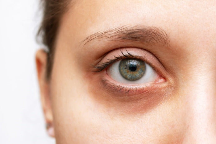 Les Cernes Noirs Sous Les Yeux : Causes et Solutions Efficaces