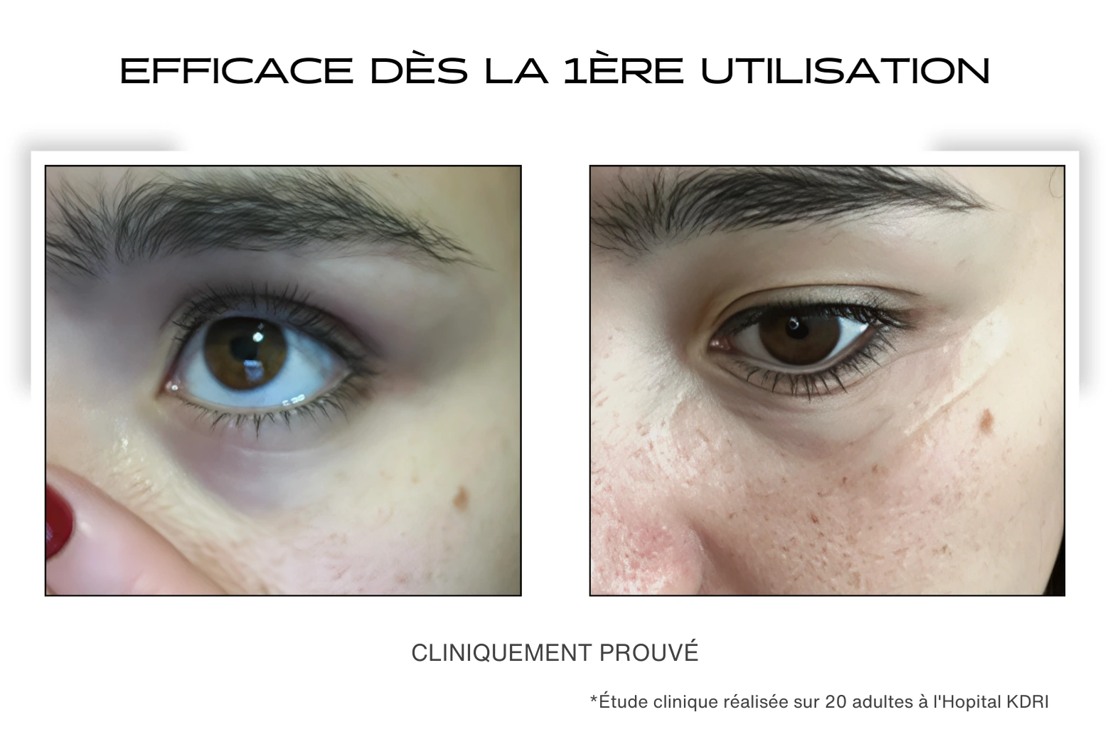 Avant / Après sur les cernes pour le patch contour des yeux microneedling