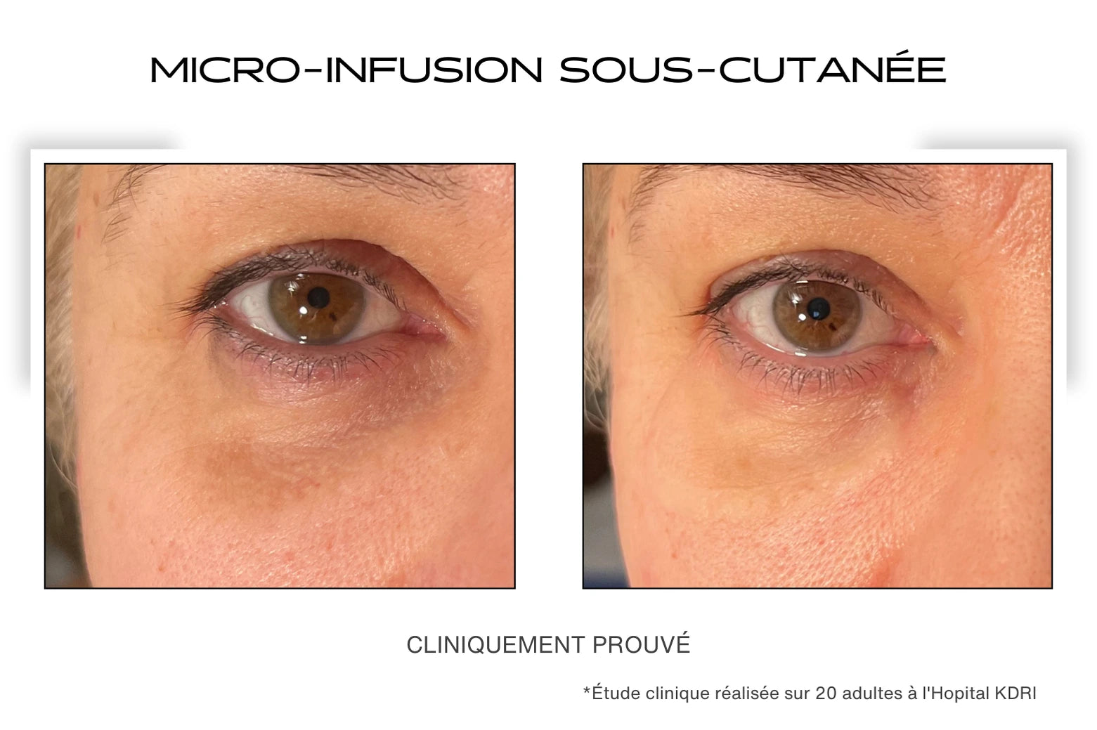 Avant / Après sur les rides et poches pour le patch contour des yeux microneedling