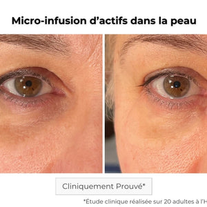 Avant Après utilisation du patch contour des yeux à micro-aiguilles pour les rides