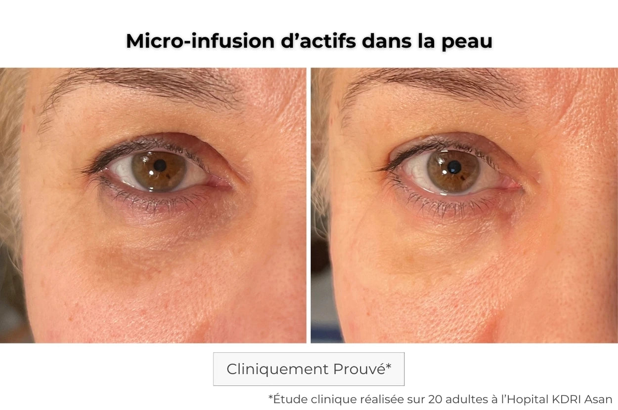 Avant Après utilisation du patch contour des yeux à micro-aiguilles pour les rides
