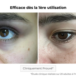 Avant Après utilisation du patch contour des yeux pour les cernes