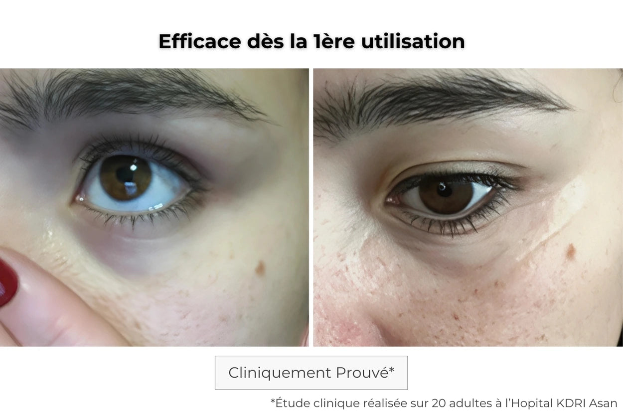Avant Après utilisation du patch contour des yeux pour les cernes