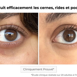 Avant Après utilisation du patch contour des yeux à micro-aiguilles pour les cernes et poches