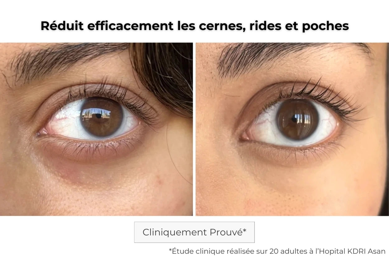 Avant Après utilisation du patch contour des yeux à micro-aiguilles pour les cernes et poches