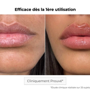 Avant Après utilisation du patch lèvres à micro-aiguilles pour hydrater les lèvres en profondeur