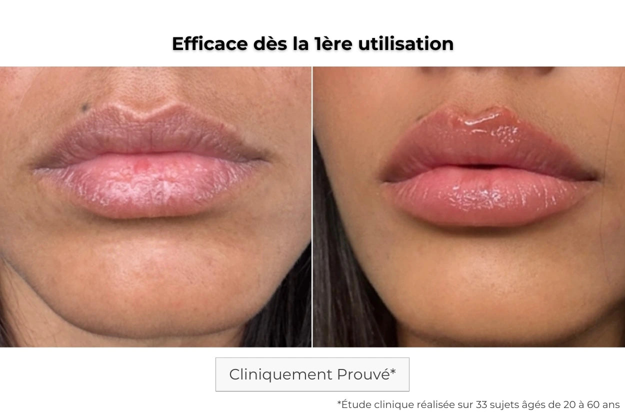 Avant Après utilisation du patch lèvres à micro-aiguilles pour hydrater les lèvres en profondeur