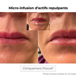 Avant Après utilisation du patch lèvres à micro-aiguilles pour repulper