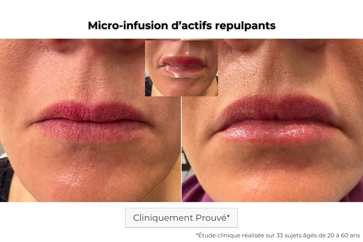 Avant Après utilisation du patch lèvres à micro-aiguilles pour repulper