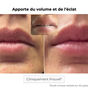 Avant Après utilisation du patch lèvres à micro-aiguilles pour donner du volume et lisser les lèvres