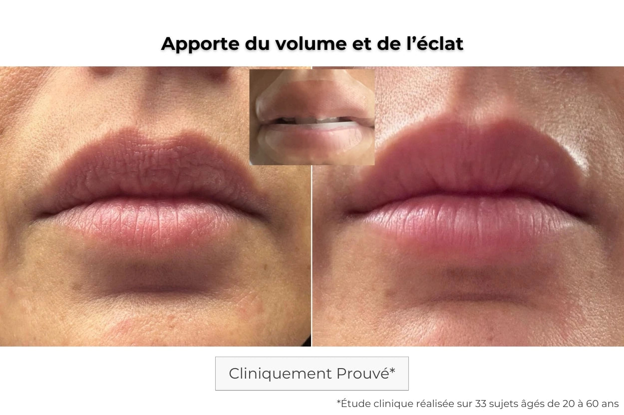 Avant Après utilisation du patch lèvres à micro-aiguilles pour donner du volume et lisser les lèvres