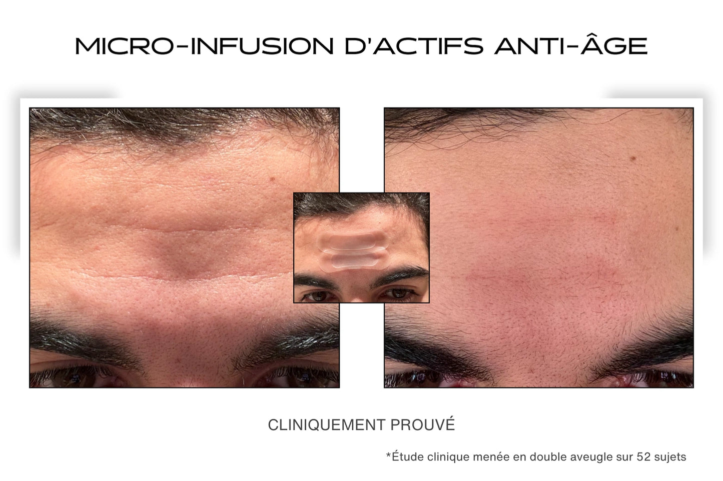 Avant / Après pour le patch anti-rides microneedling sur le front