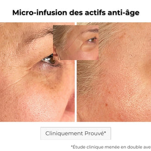 avant après utilisation du patch anti-âge sur les rides des pattes d'oies