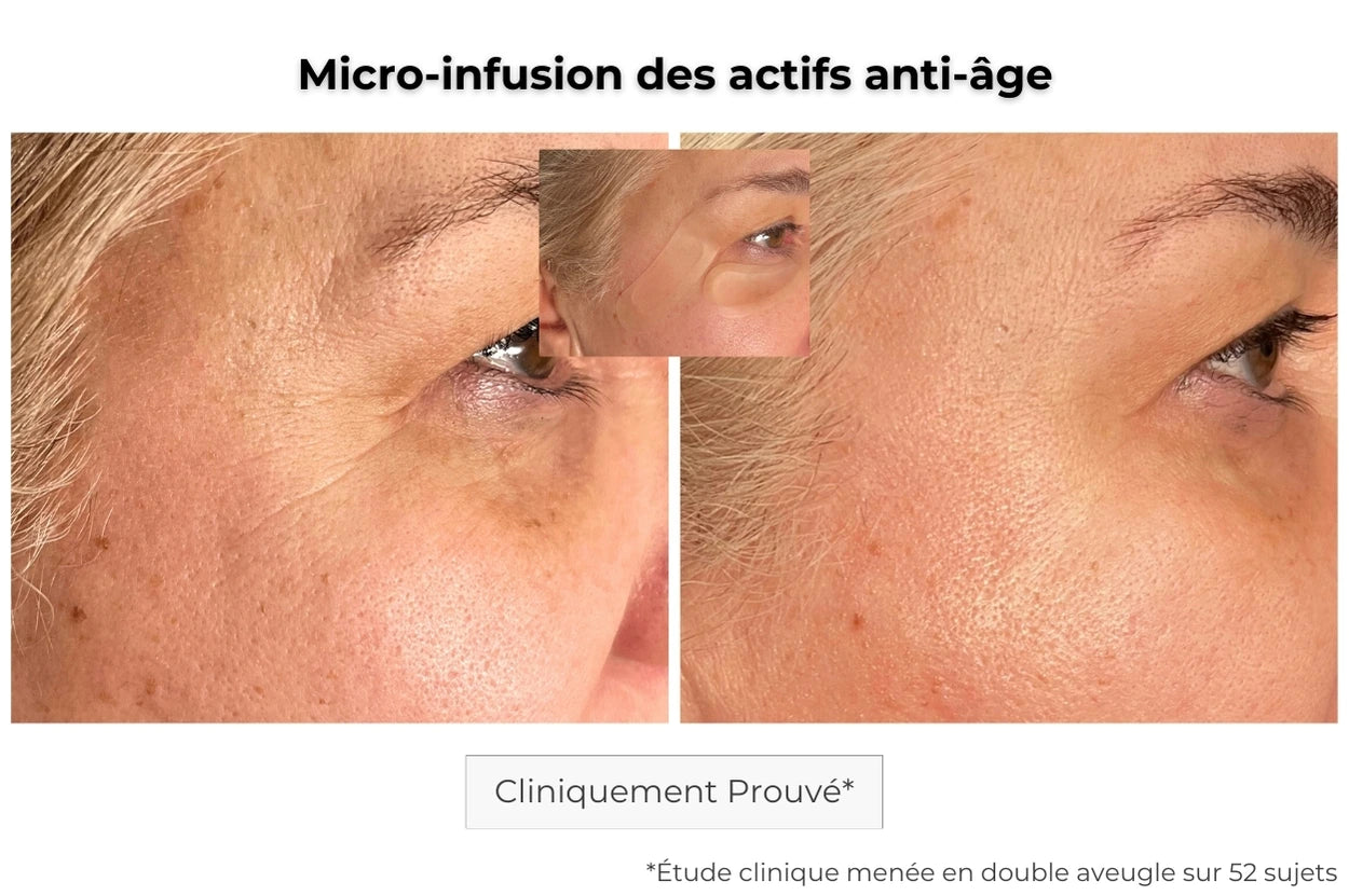 avant après utilisation du patch anti-âge sur les rides des pattes d'oies