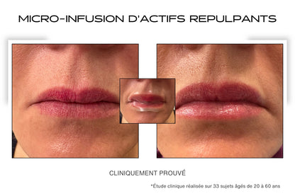Avant Après rides bouche avec le patch lèvres microneedling 