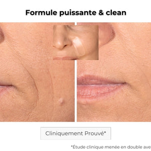 avant après utilisation du patch anti-âge sur les rides des sillons nasogéniens