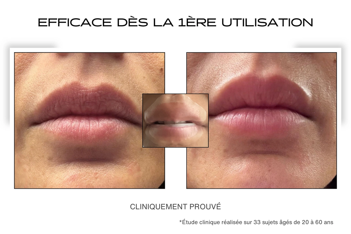 Avant Après volume avec le patch lèvres microneedling 