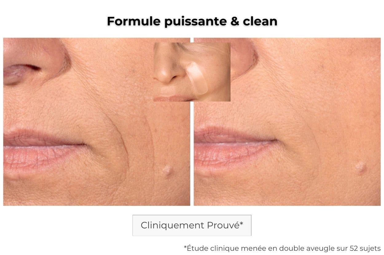 avant après utilisation du patch anti-âge sur les rides des sillons nasogéniens