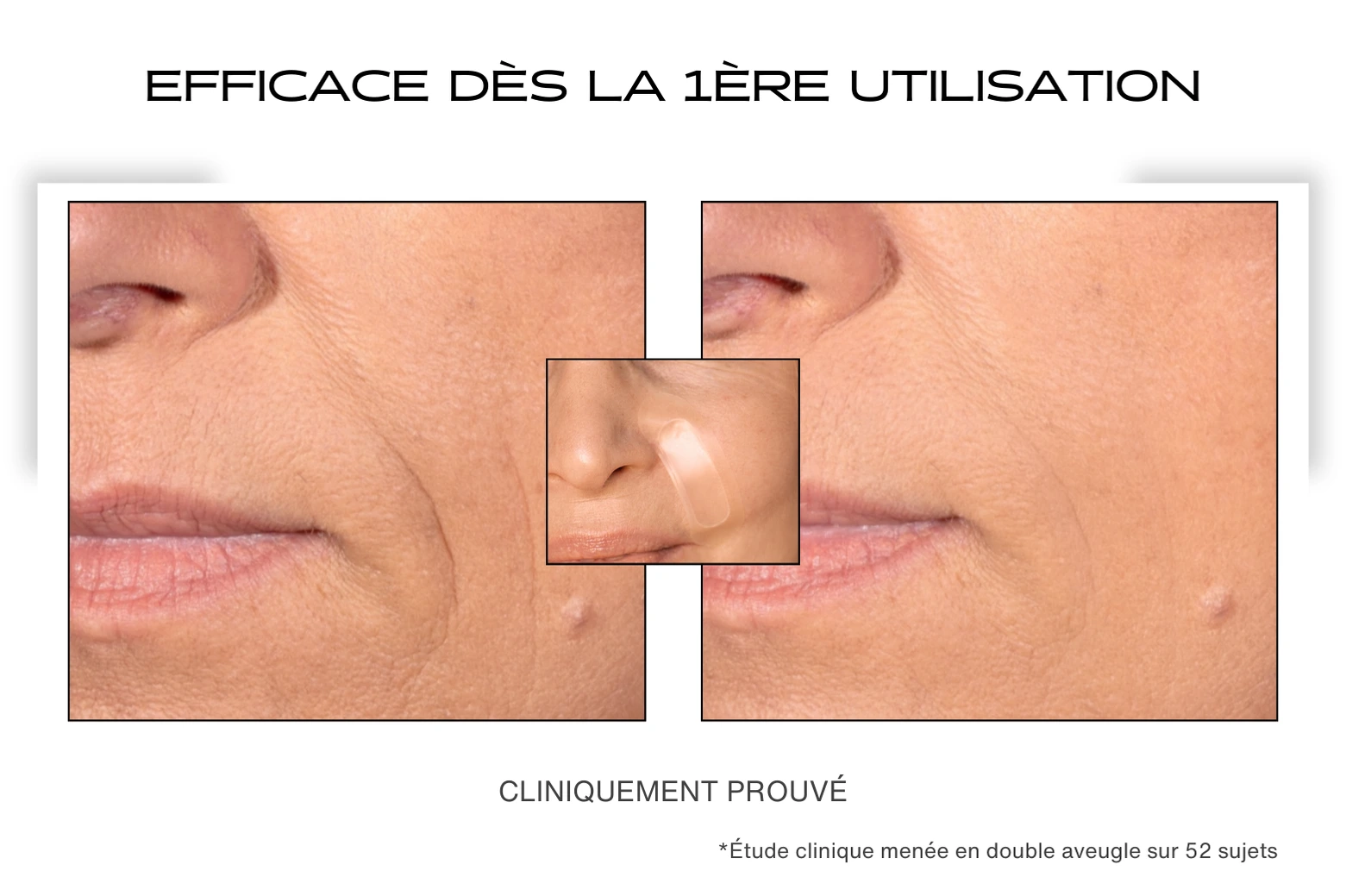 Avant / Après pour le patch anti-rides sur le sillon nasogénien