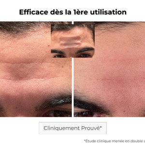 Avant Après utilisation du patch anti-âge pour les rides et ridules du front