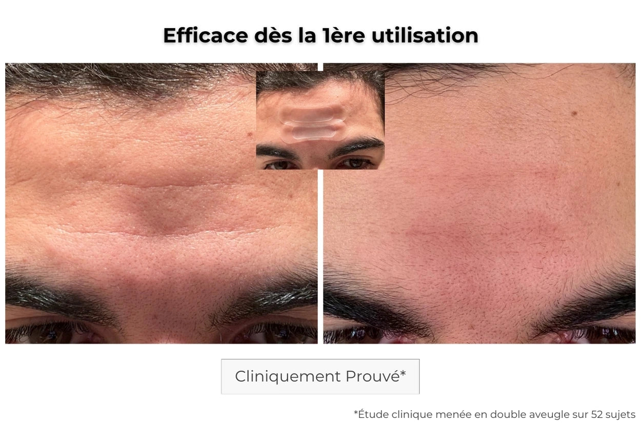 Avant Après utilisation du patch anti-âge pour les rides et ridules du front