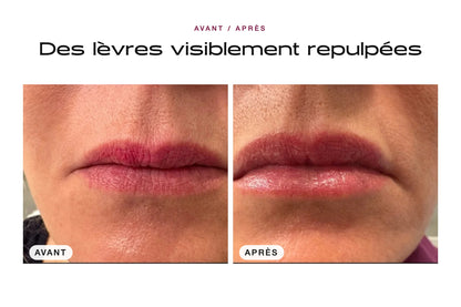 Avant / après : lèvres visiblement repulpées avec le Patch Lèvres